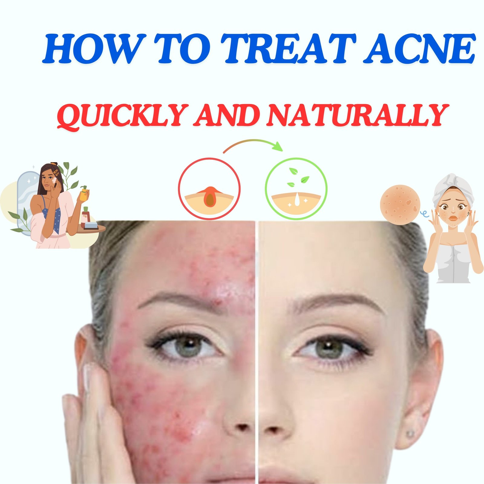 How to treat acne quickly and naturally