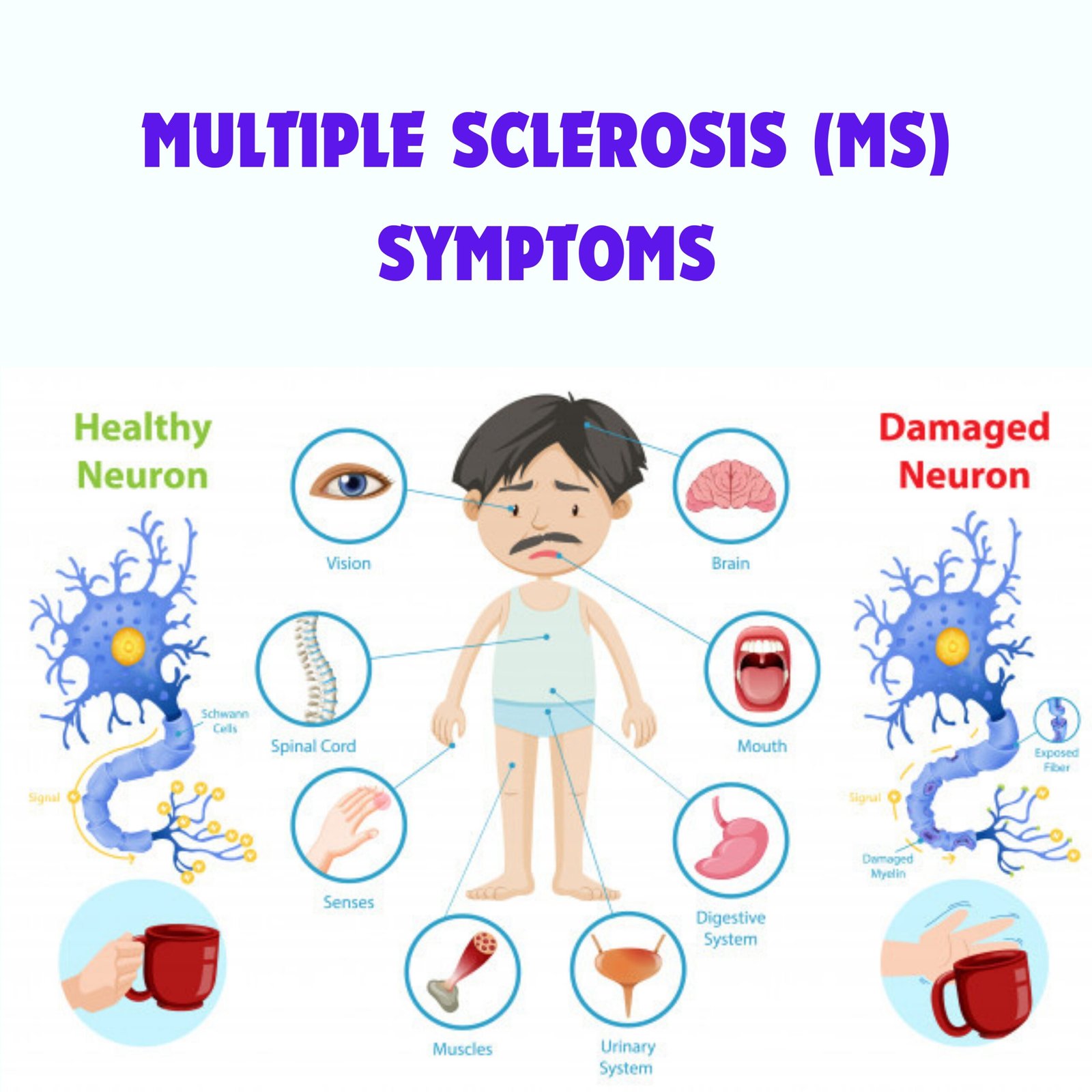 MULTIPLE SCLEROSIS (MS)
