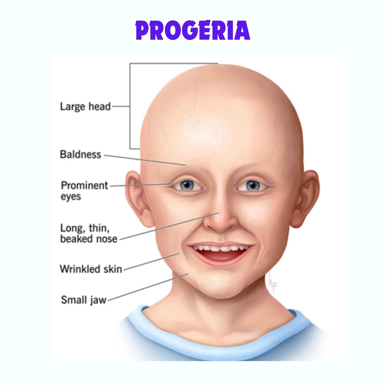 CAUSE,DIAGNOSIS,SYMPTOMS AND TREATMENT OF PROGERIA