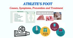 CAUSES, SYMPTOMS AND TREATMENT